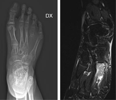 Reconstruction of metatarsal bone after giant cell tumor resection with no vascularized fibular graft in a pediatric patient: Case report and review of literature